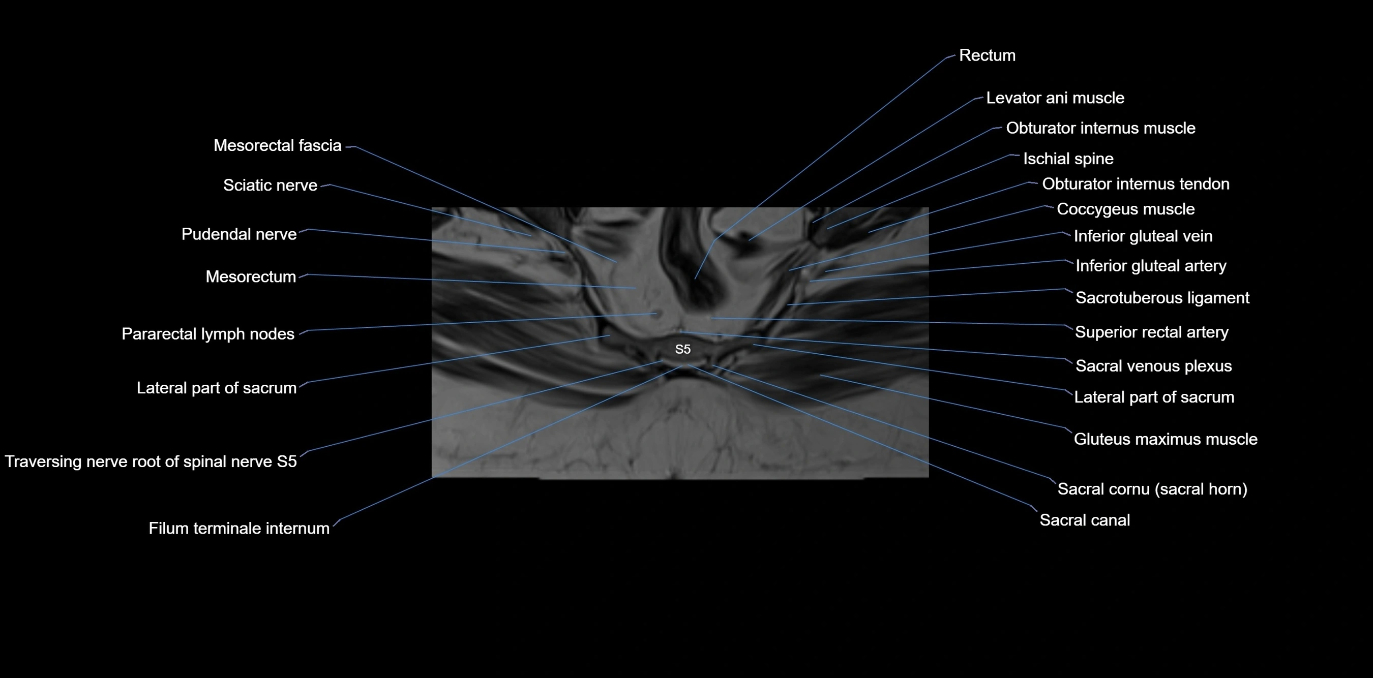 MRI sacrum, coccyx and sacroiliac joint axial cross sectional anatomy 3T  radiology  image-img-00001-00057.webp
